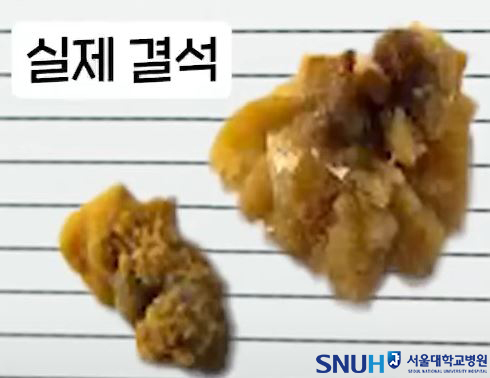 '조용한 암살자' 요로결석 오해와 진실…맥주 마시면 더 악화-비타민D 과다섭취도 금물